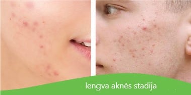 AKNIX Intensive Purifying Care kremas 1-ai aknės stadijai, 40 g