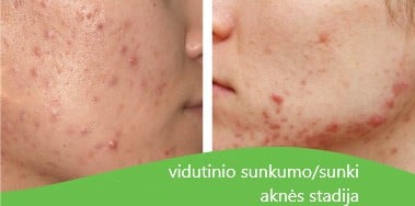 AKNIX Intensive Global Care kremas